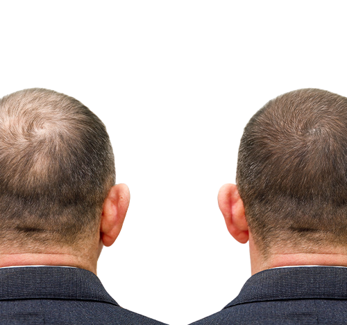 Trapianto di capelli