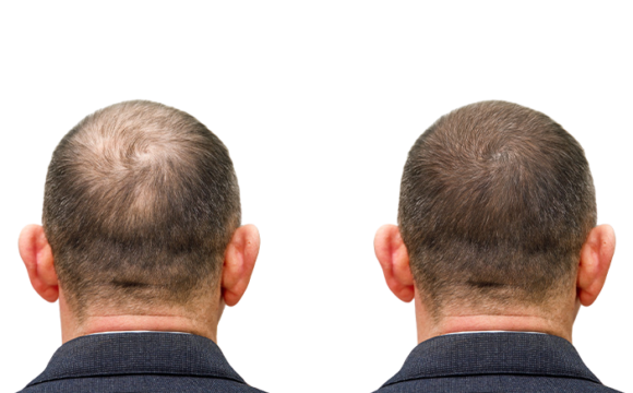 Trapianto capelli - interna Trapianto di capelli