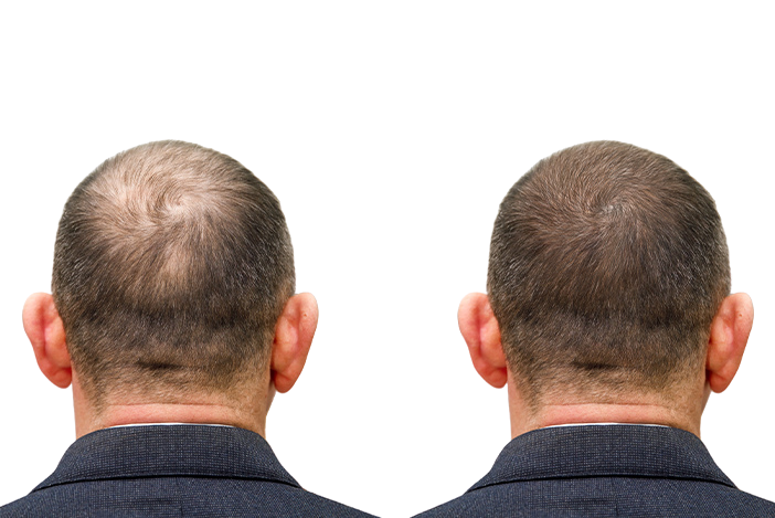 Trapianto di capelli